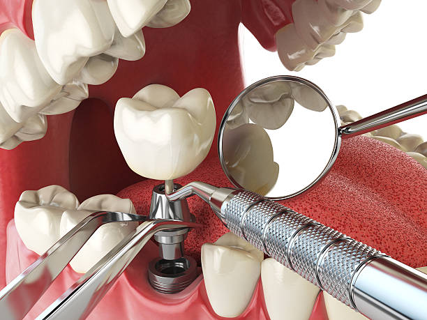 Best Emergency Dentist for Knocked-Out Tooth in Rochester Institute Of Technology, NY